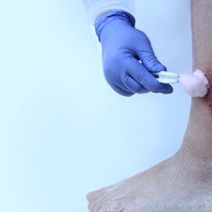 salusone-ulceras-extremidades-inferiores salusone-ulceras-extremidades-inferiores